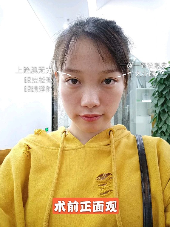 术前一宽一窄的双眼皮导致了大小眼的形成,上睑肌无力,眼皮松弛 乌鲁木齐华美整形割双眼皮案例图 技术怎么样?多少钱