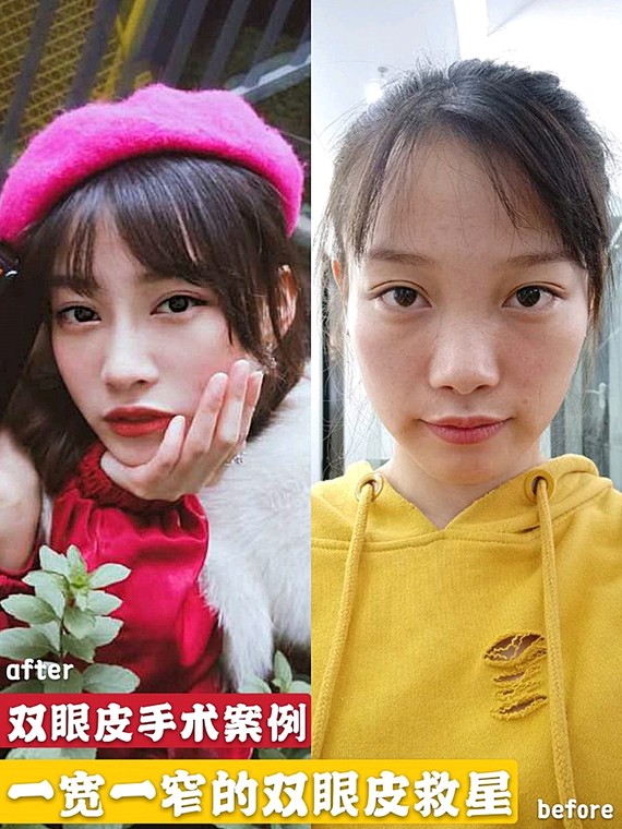 术前一宽一窄的双眼皮导致了大小眼的形成,上睑肌无力,眼皮松弛 乌鲁木齐华美整形割双眼皮案例图 技术怎么样?多少钱