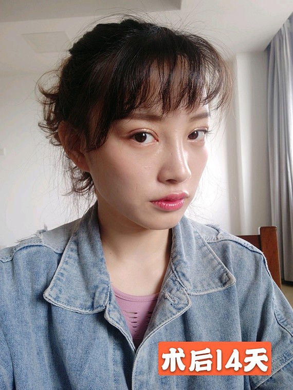 术前一宽一窄的双眼皮导致了大小眼的形成,上睑肌无力,眼皮松弛 乌鲁木齐华美整形割双眼皮案例图 技术怎么样?多少钱