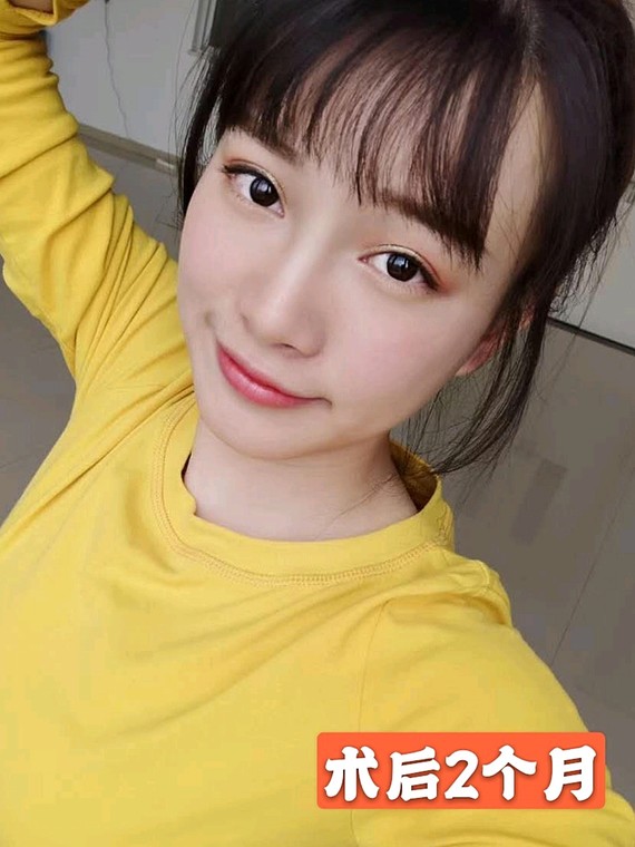 术前一宽一窄的双眼皮导致了大小眼的形成,上睑肌无力,眼皮松弛 乌鲁木齐华美整形割双眼皮案例图 技术怎么样?多少钱