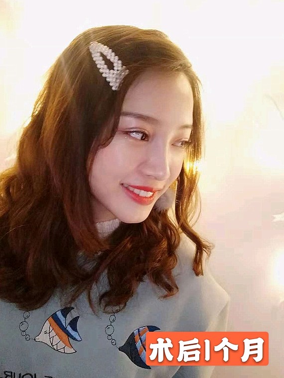术前一宽一窄的双眼皮导致了大小眼的形成,上睑肌无力,眼皮松弛 乌鲁木齐华美整形割双眼皮案例图 技术怎么样?多少钱