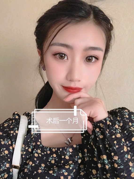 双眼皮手术近视也可以做吗?