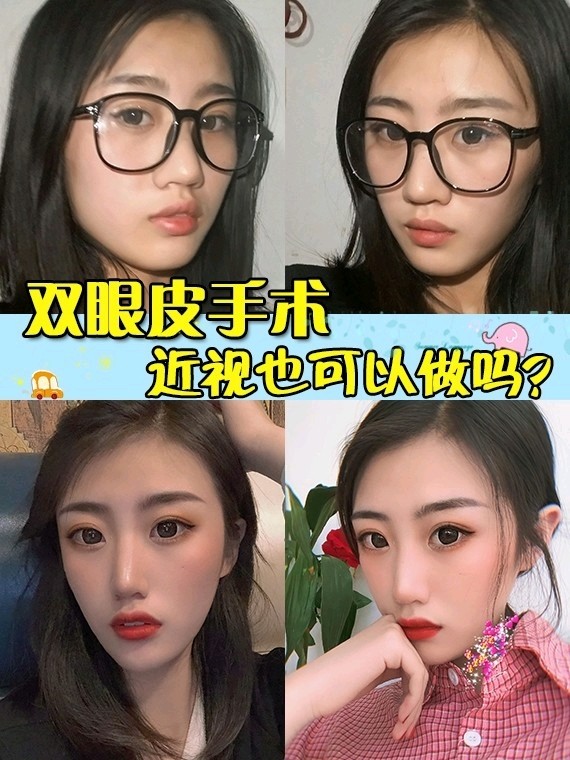 双眼皮手术近视也可以做吗?
