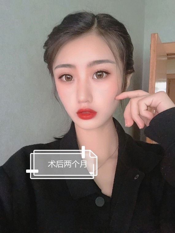 双眼皮手术近视也可以做吗?