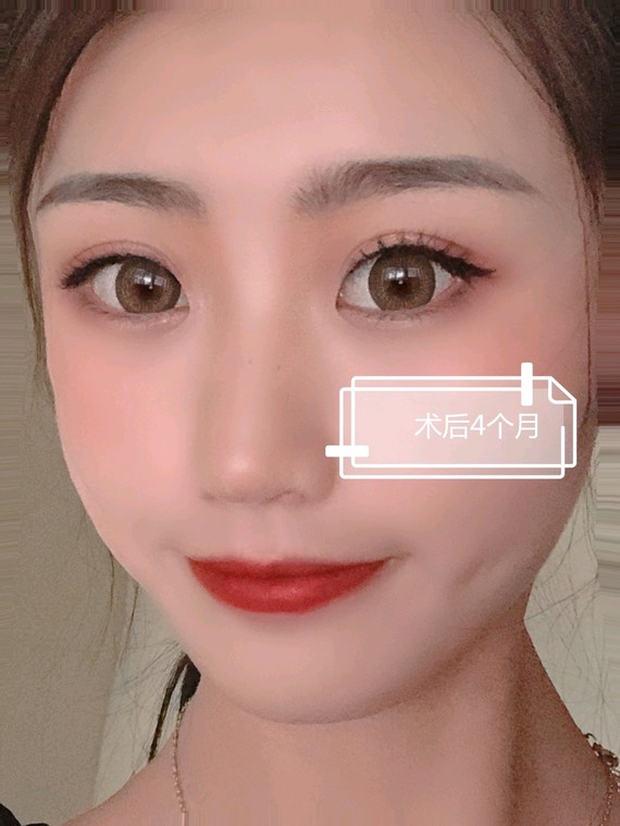 双眼皮手术近视也可以做吗?