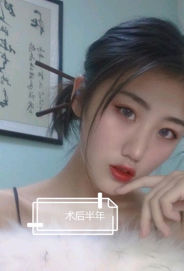 双眼皮手术近视也可以做吗?