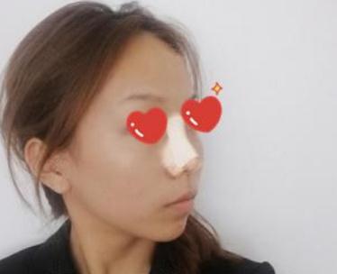 做软骨+假体隆鼻后,猪小鼻不见叻!芜湖伊莱美隆鼻技术怎么样?案例图好看吗?