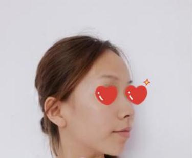 做软骨+假体隆鼻后,猪小鼻不见叻!芜湖伊莱美隆鼻技术怎么样?案例图好看吗?