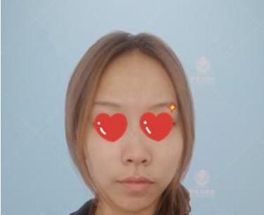 做软骨+假体隆鼻后,猪小鼻不见叻!芜湖伊莱美隆鼻技术怎么样?案例图好看吗?