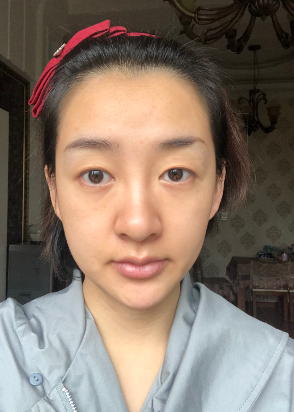 定制的自体软骨移植隆鼻和割双眼皮整形术让我成为女神!北京沃尔整形刘彦军隆鼻技术怎么样?案例图分享