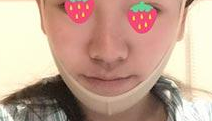下颌角截骨术后*果如何?担心下颌角截骨的*果不*下颌角截骨术后,我的脸仍然很方很宽