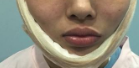 下颌角截骨术后*果如何?担心下颌角截骨的*果不*下颌角截骨术后,我的脸仍然很方很宽