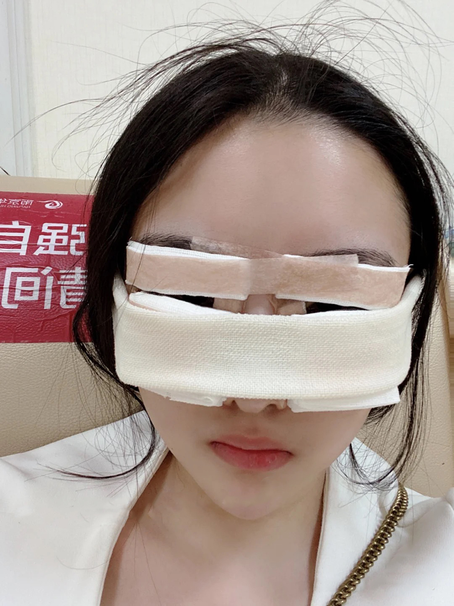我之前鼻子做过*和打过玻尿酸,原始鼻子用我朋友的话来讲就是脸上只有个大鼻头。