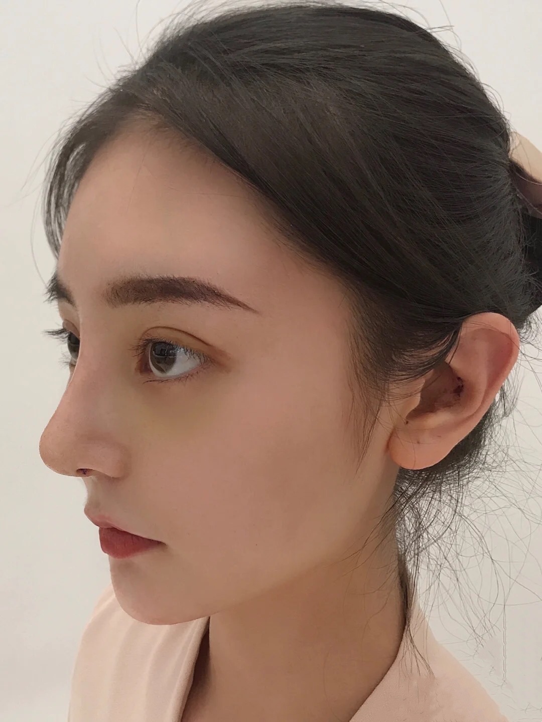 我之前鼻子做过*和打过玻尿酸,原始鼻子用我朋友的话来讲就是脸上只有个大鼻头。