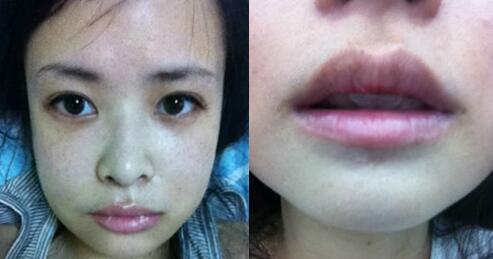 北京面部填充+下颌角手术我的换脸路程
