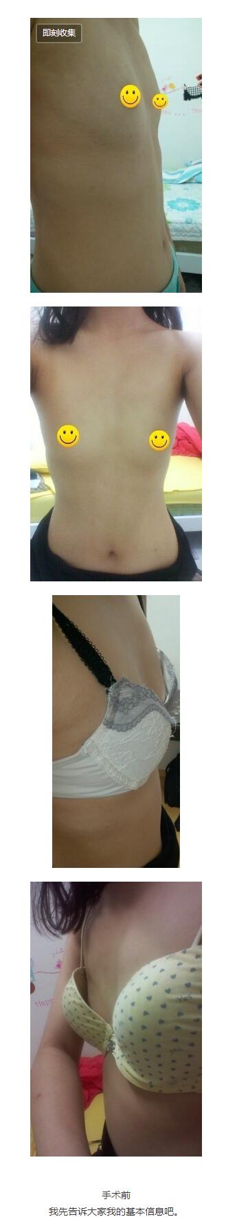 70A到70C的改变 我在4个月前做了水滴形假体隆胸整形手术。广州美莱整形医院假体隆胸案例图