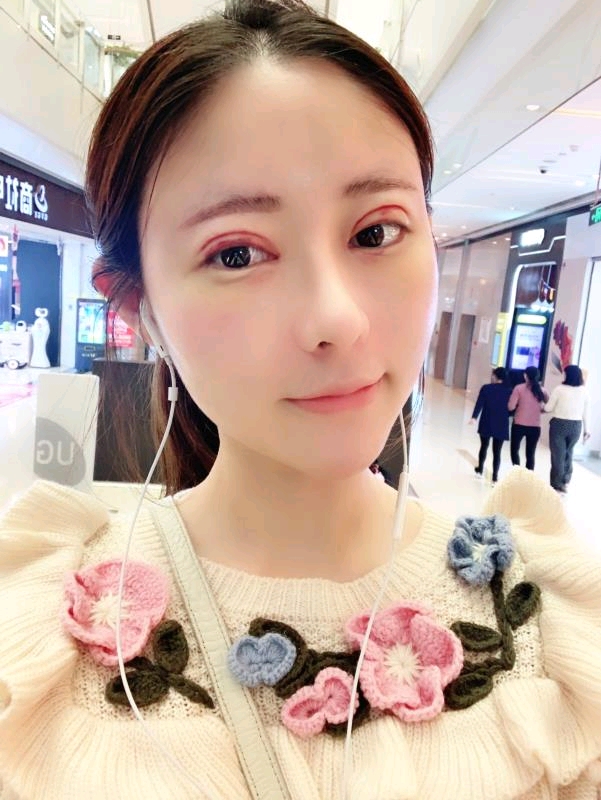 祁佐良·北京八大处整形外科医院割双眼皮案例图 在线预约