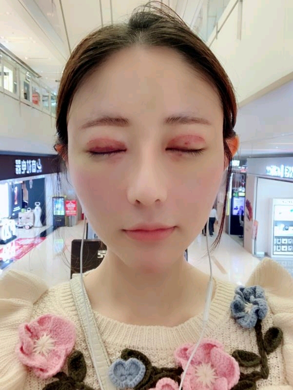祁佐良·北京八大处整形外科医院割双眼皮案例图 在线预约