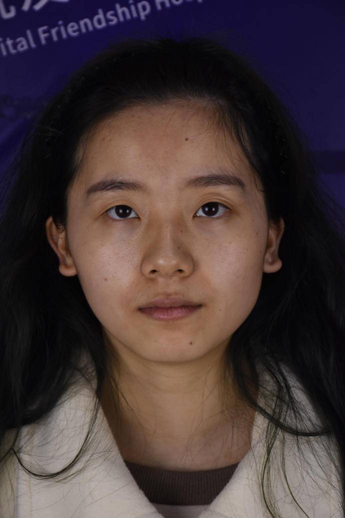 南通大学附属医院整形科医生有哪些？双眼皮隆鼻案例图·在线预约