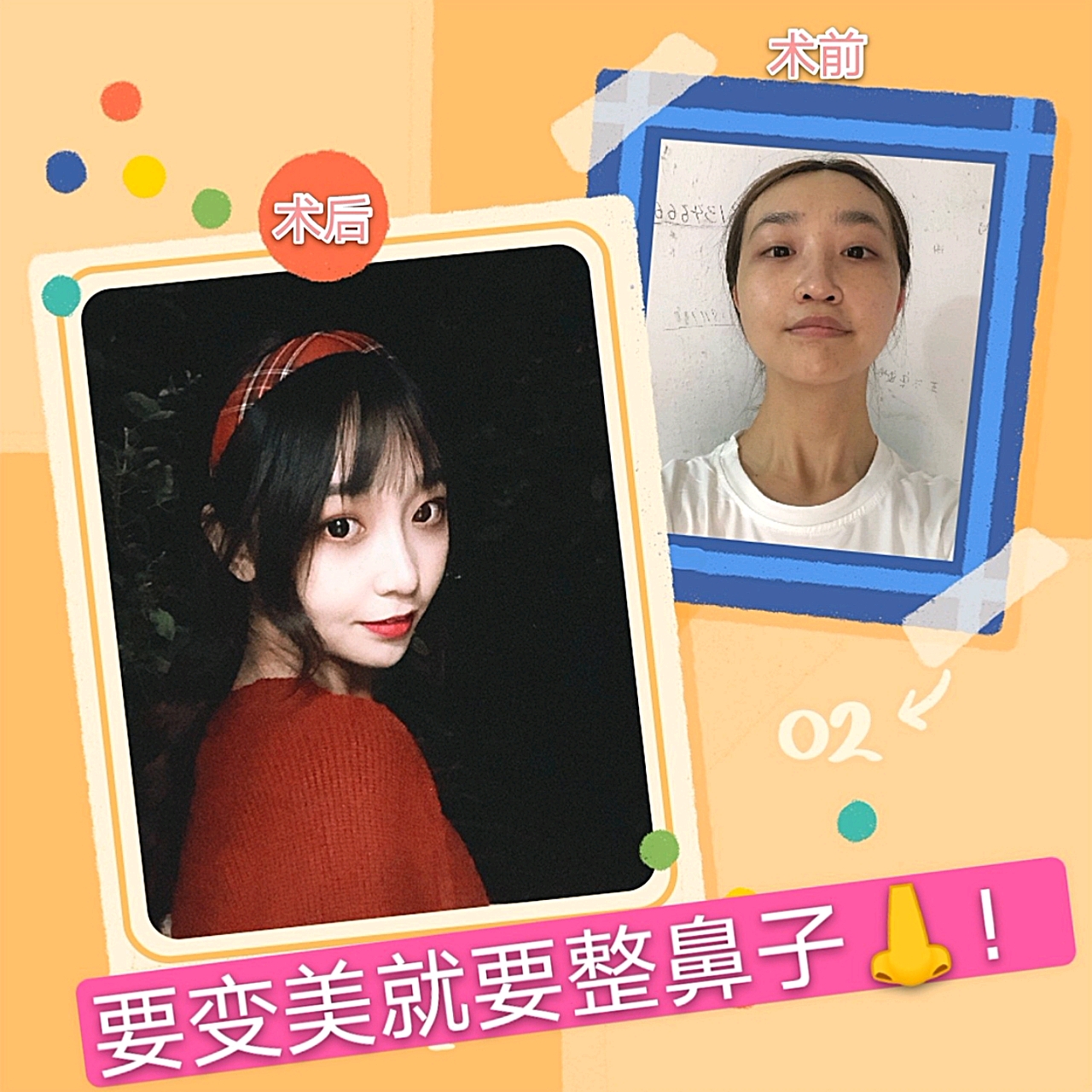 【于浩】北京八大处整形外科医院副主任医师技术怎么样?隆鼻案例图分享