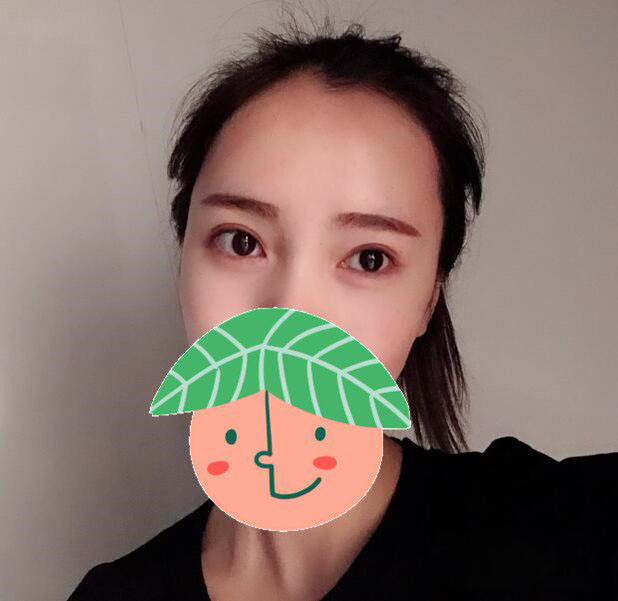 【郭鑫】北京医科整形八大处门诊部主任技术怎么样?面部吸脂案例图好看吗?