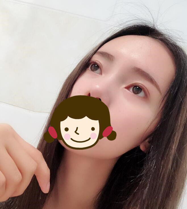 【郭鑫】北京医科整形八大处门诊部主任技术怎么样?面部吸脂案例图好看吗?