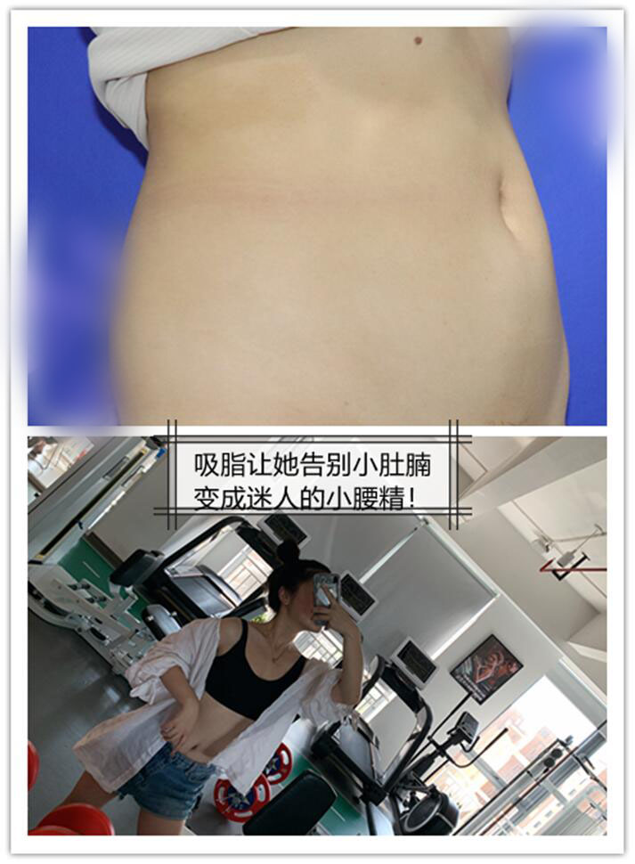 吸脂让她告别小肚腩变成迷人的小腰精!