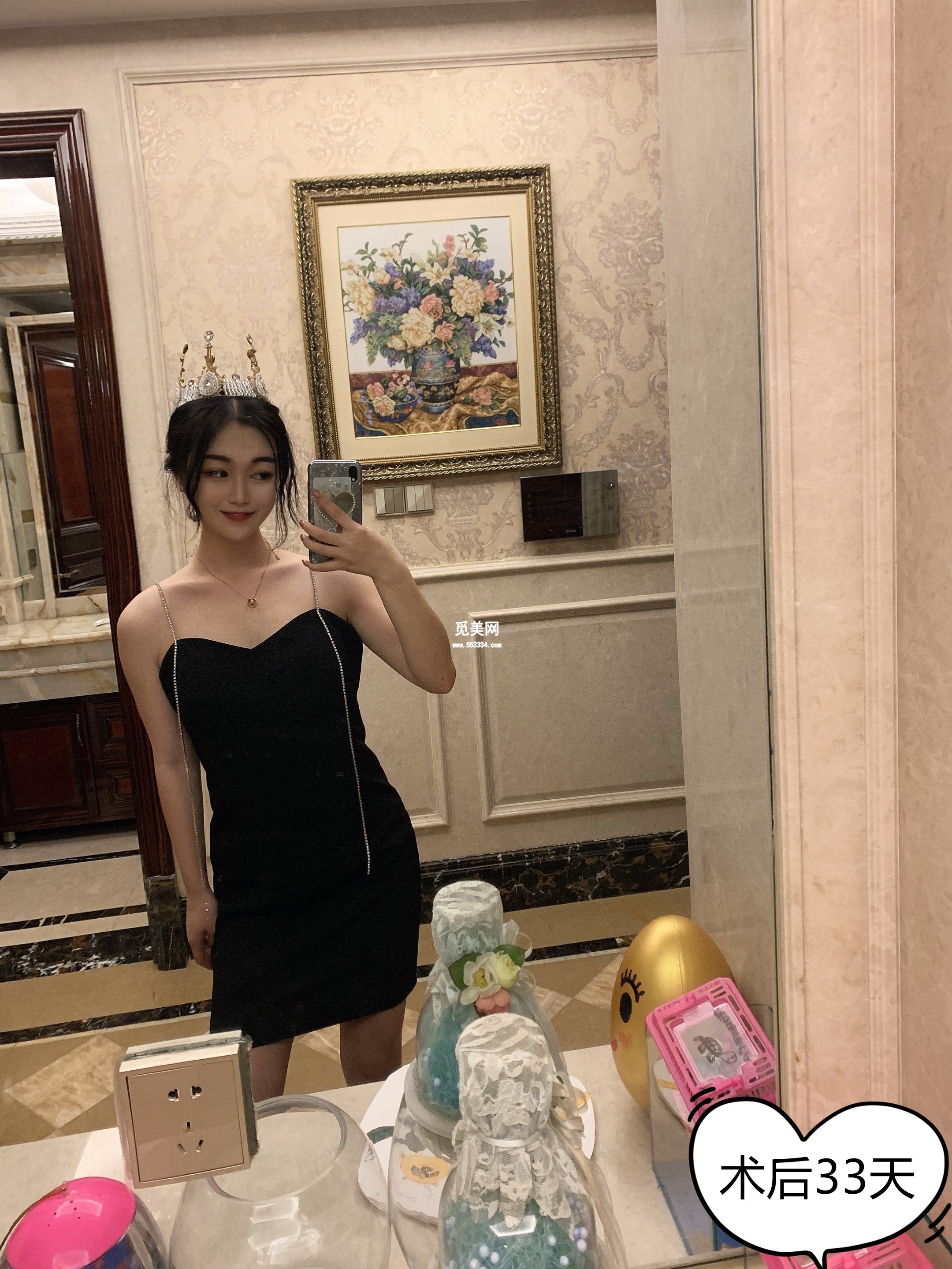 吸脂让她告别小肚腩变成迷人的小腰精!