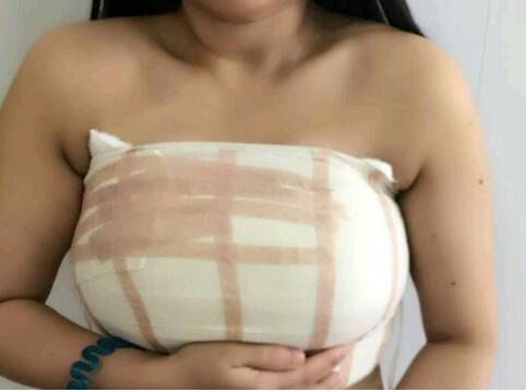 北京八大处马桂娥巨乳缩小、隆胸怎么样？多少钱？案例图