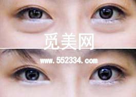 东莞知美祛眼袋怎么样?多少钱?案例图