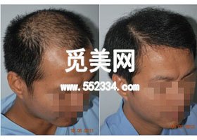 植发 我不再是“地中海”了 济南韩氏头发种植多少钱?技术怎么样?案例图