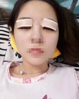 从小她就是单眼皮、小眼睛 成都米兰柏羽双眼皮高亮割的怎么样?案例图有吗?多少钱?