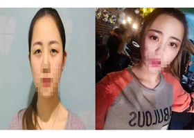从小她就是单眼皮、小眼睛 成都米兰柏羽双眼皮高亮割的怎么样?案例图有吗?多少钱?