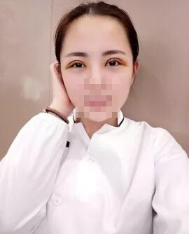 从小她就是单眼皮、小眼睛 成都米兰柏羽双眼皮高亮割的怎么样?案例图有吗?多少钱?