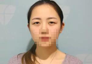 从小她就是单眼皮、小眼睛 成都米兰柏羽双眼皮高亮割的怎么样?案例图有吗?多少钱?