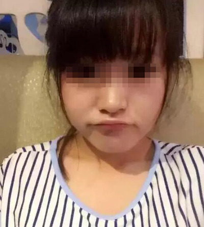 脸型太过肥大了一直是我的烦恼*注射 广州曙光打*多少钱?*果图怎么样?案例图