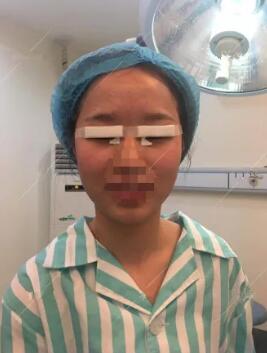 北京大学深圳医院主任医师李天石双眼皮手术 *果不错 案例图