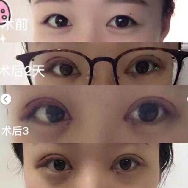 到杭州市第一人民医院周景和医生做的双眼皮+开内眼角 *果很棒 案例图