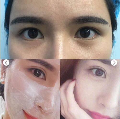 武汉省医院整形科做双眼皮多少钱?吴小蔚怎么样?手术真实案例分享