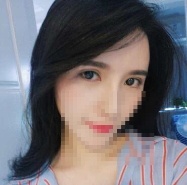 武汉省医院整形科做双眼皮多少钱?吴小蔚怎么样?手术真实案例分享