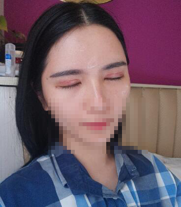 武汉省医院整形科做双眼皮多少钱?吴小蔚怎么样?手术真实案例分享