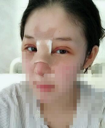 武汉五洲整形医院王志医生假体隆鼻+双眼皮案例分享 技术怎么样？多少钱？