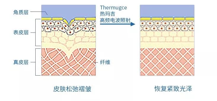 热玛吉紧肤多少钱?多少岁适合做热玛吉?