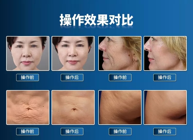 热玛吉紧肤多少钱?多少岁适合做热玛吉?