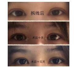 2019年6月8日在上海第九人民医院肖开颜医生处做的全切双眼皮、内眼角，手术价格11268元
