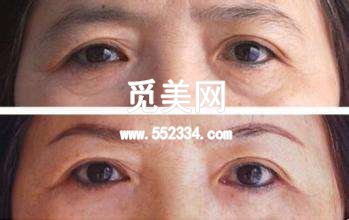 切眉和提眉有区别吗?区别是什么?手术*果的比较