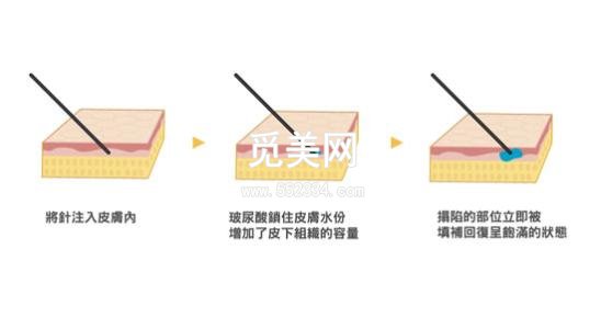 美容注射玻尿酸副作用?如何避免美容注射玻尿酸副作用