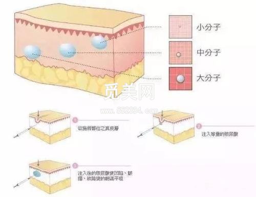 美容注射玻尿酸副作用?如何避免美容注射玻尿酸副作用
