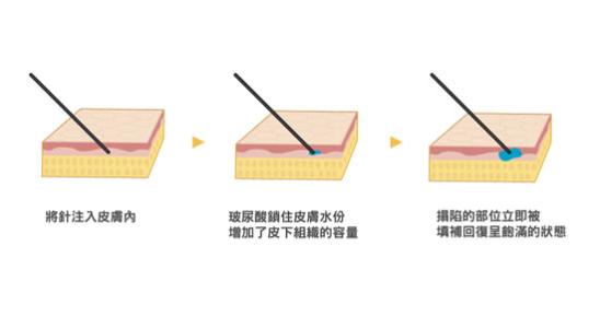 美容注射玻尿酸副作用,如何避免美容注射玻尿酸副作用,美容注射玻尿酸价格