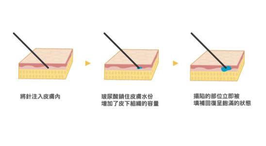 美容注射玻尿酸副作用，如何避免美容注射玻尿酸副作用，美容注射玻尿酸价格